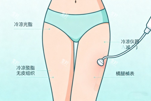 腿部做吸脂卡通图一览.jpg